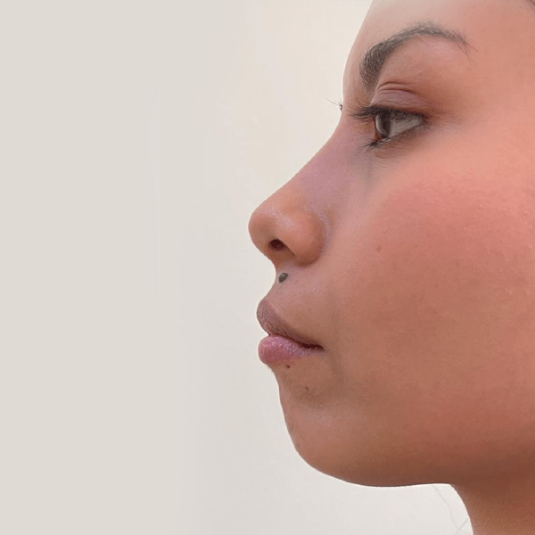 foto_relleno_labios